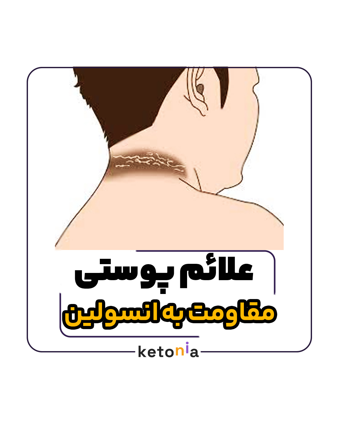 علائم پوستی مقاومت به انسولین. مقاومت به انسولین آکانتوزیس نیگریکانس